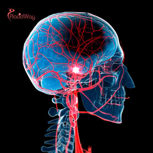 Stem Cell Therapy for Stroke Recovery in Mexico: The Complete Guide to Advanced Regenerative Treatment
